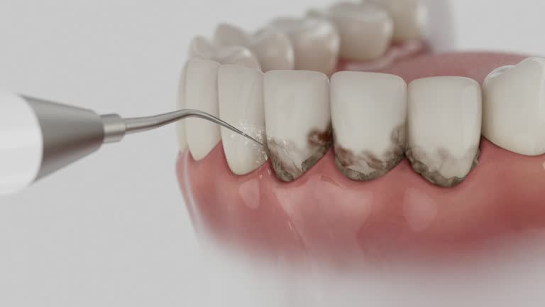 Trusted Wisdom Tooth Removal service in Georgetown, IN - Dentist Open Now